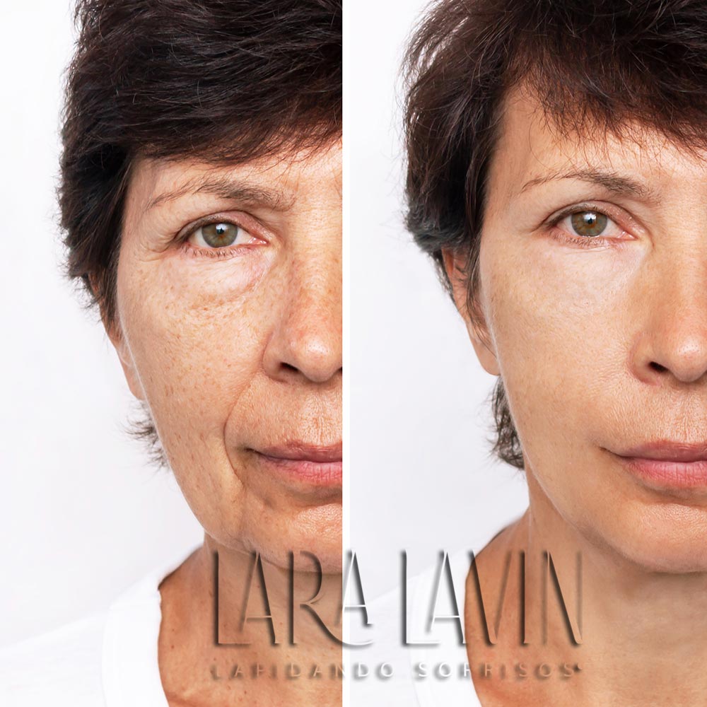 Peelings Para Melasma Dra Lara Lavin Agende Sua Avalia O