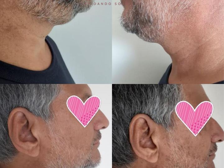 Lipo de Papada
