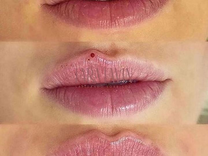 Preenchimento labial