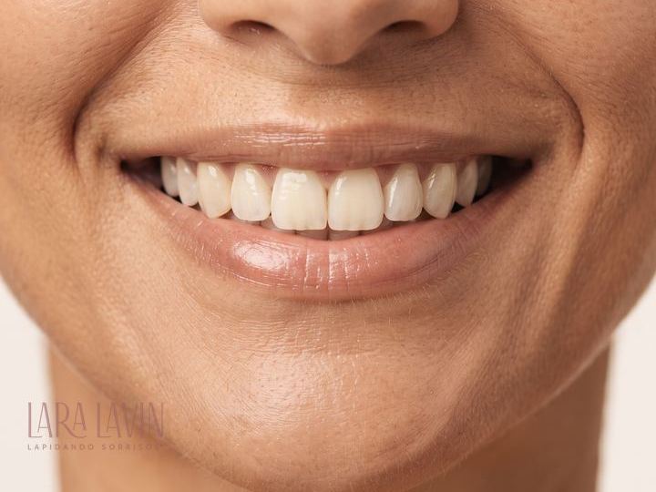 Clareamento dental a laser