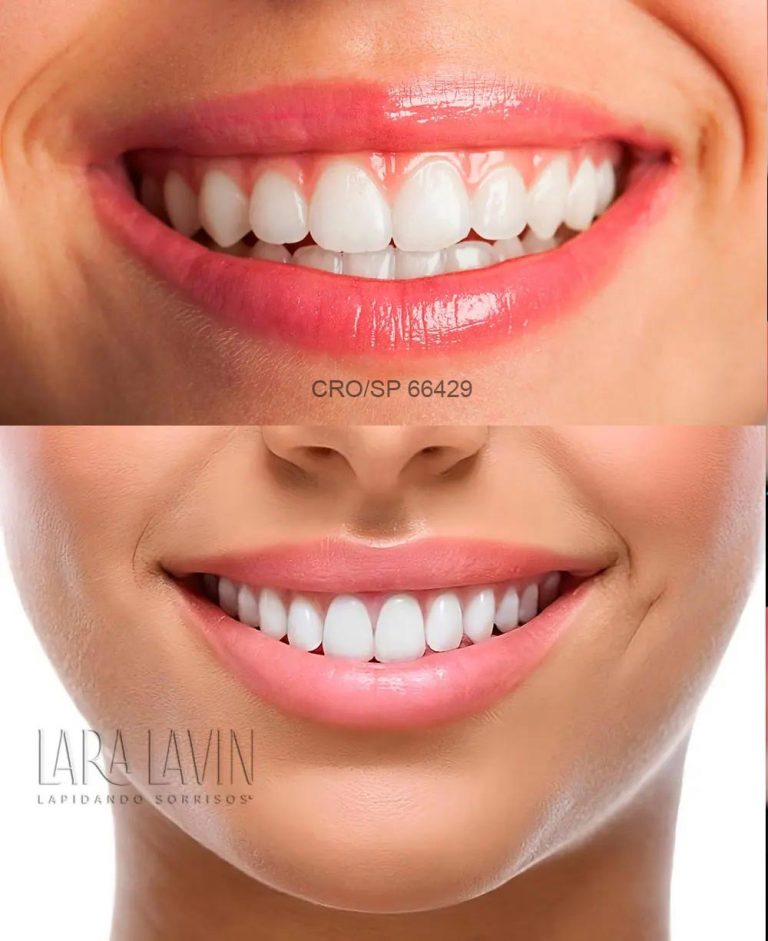 Cirurgia Plástica Gengival