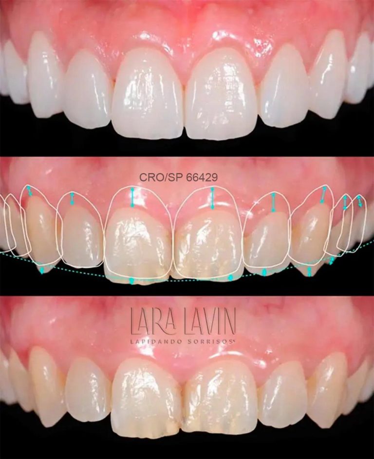 Cirurgia Plástica Gengival