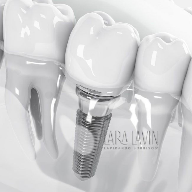 Implante Dentário