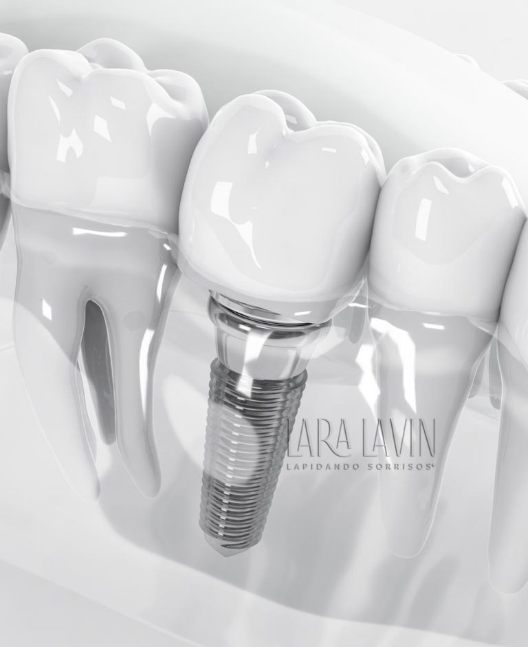 Implante Dentário