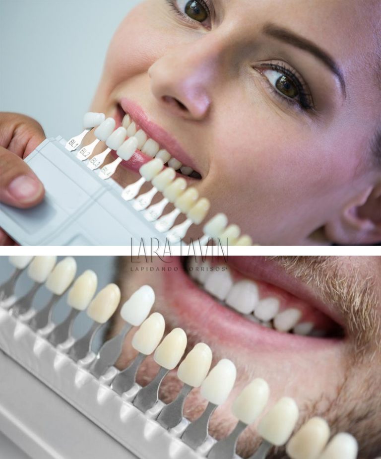 Lentes de contato dental