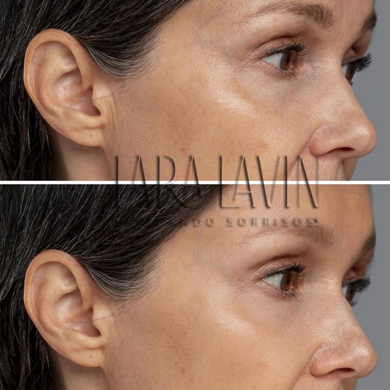 Peelings para Melasma