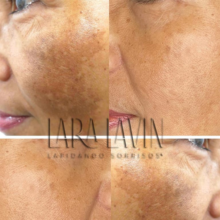 Peelings para Melasma