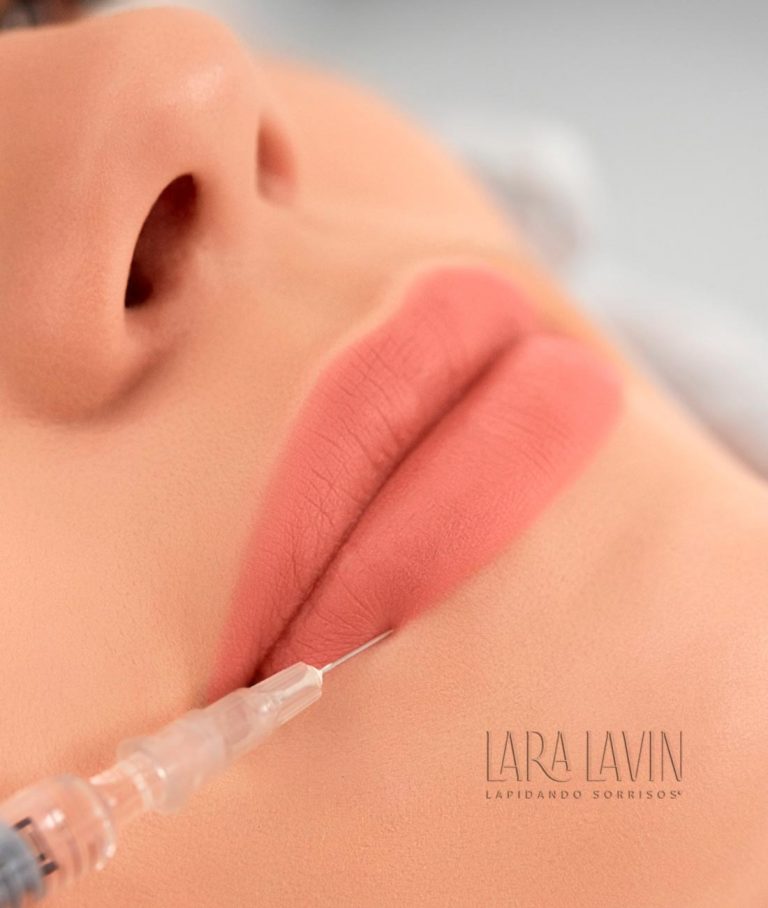 Preenchimento labial