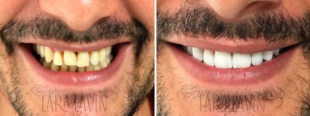 Facetas de Porcelana Antes e Depois