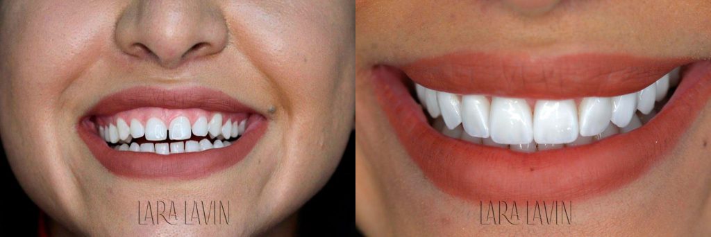 Facetas de Porcelana Antes e Depois